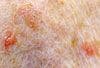 Lichenoid Keratosis: A Skin Cancer Mimic
