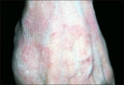 Localized Eczema: What Cause?