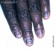 Psoriasis of the Nail
