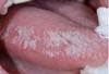 White Tongue Lesions: Candida, Contact Stomatitis, Oral Lichen Planus?