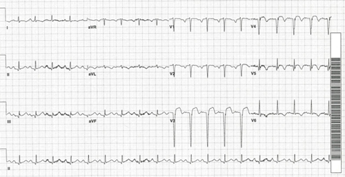 Admission electrocardiogram revealing significant ST-segment elevation