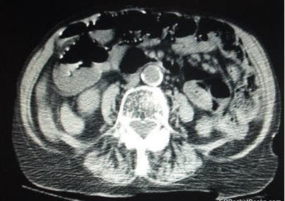 Mid-epigastric Pain and Emesis in a 95-Year-Old Woman 