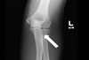 FOOSH Injury of the Elbow