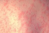 Measles 2011: The Latest Import From Europe