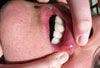 Aphthous Ulcers (Canker Sores)