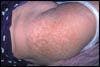 Can you identify this asymptomatic reticular eruption?