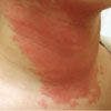 Allergic Contact Dermatitis From Tea Tree Oil