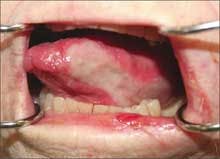 Aged Woman With Sudden Striking and Unfamiliar Oral Lesion
