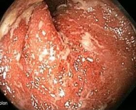 Perianal Pain Associated With Crohn Colitis: What Next?  
