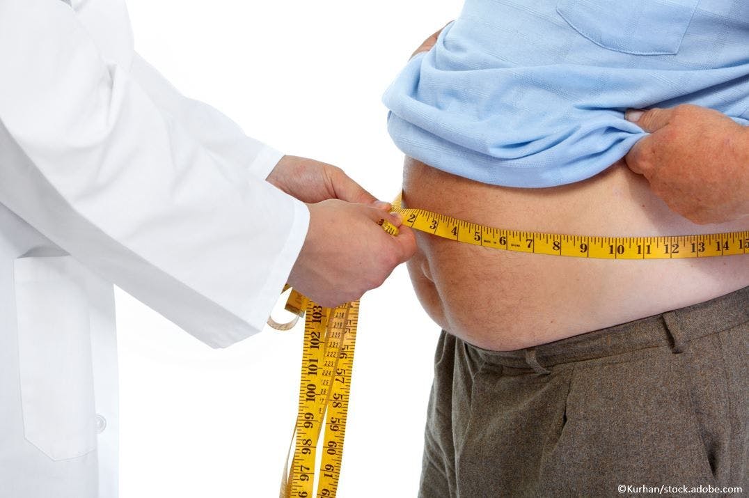 Morbid obesity associated with increased hospitalization for diverticulitis 