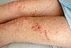 Acute Allergic Contact Dermatitis to Poison Ivy