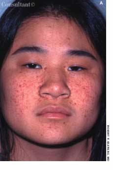 Tuberous Sclerosis in a 15-Year-Old Girl