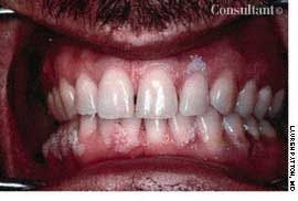 Oral Condyloma Acuminatum (Venereal Warts)