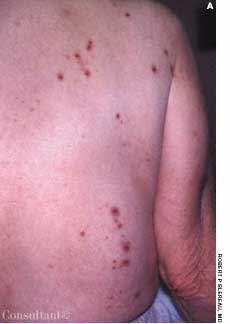 Acquired Reactive Perforating Collagenosis on a Woman's Back