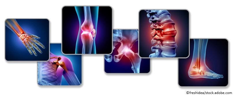 Osteoarthritis Projected to Affect Nearly 1 Billion by 2050, Obesity Major Contributing Factor  image credit joint pain  ©fresh idea/stock.adobe.com