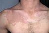 Tinea Versicolor on the Chest of a Young Man