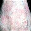 What clue points to the cause of this pruritic rash?