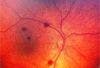 Retinal Hemorrhages in an Infant: Abuse-or Mimic? Quiz of the Week