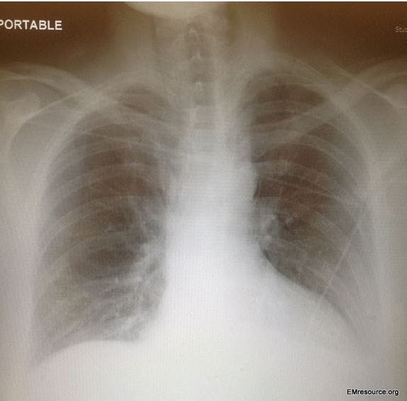 Pneumomediastinum caused by Boerhaave syndrome