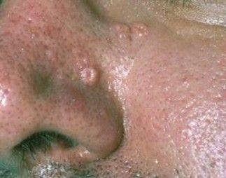 Skin Cancer-or Something Else?