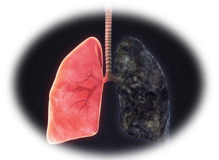 Early CT Screening Significantly Improves Survival in Lung Cancer image credit ©nerthuz/stock.adobe.com