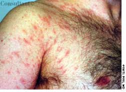 Pityriasis Rosea on Chest, Neck, and Back of a 35-Year-Old Man
