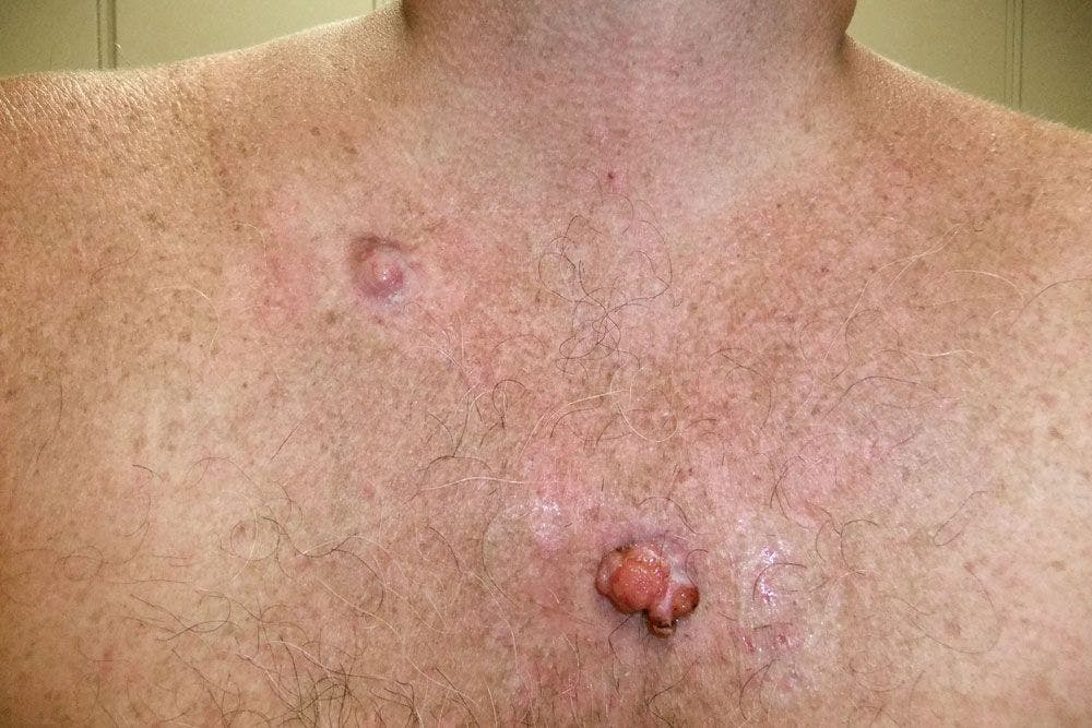 Pearly Pink Chest Lesions 