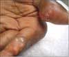 Chronic Tophaceous Gout