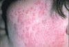 Why has a topical corticosteroid failed to clear this rash?