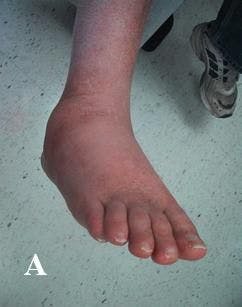 Hot Swollen Foot in a Man With Diabetes: Image IQ
