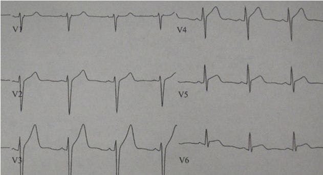 Myocarditis in a young man with URI