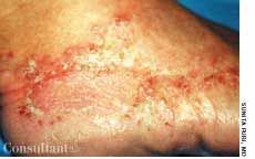 Dermatitis Caused by Shoes