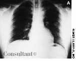 Solitary Pulmonary Nodule: TB or not TB