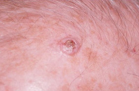 Squamous Cell Carcinoma of the Scalp