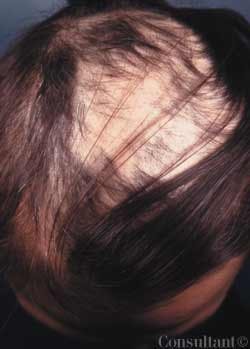 Trichotillomania in a 40-Year-Old Woman