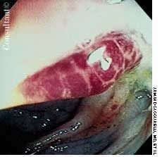Kaposi's Sarcoma in the Sigmoid Colon