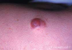 Pilomatrixoma on the Shoulder of a 14-Year-Old Girl