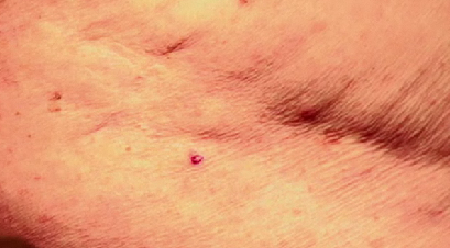 Skin Surgery Techniques: Punch Biopsy