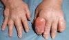 Gout Diagnosis: 4 Common Misconceptions