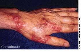 Tuberculoid Leprosy