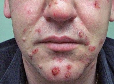 Too old for acne?