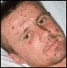 Young Man With a Mildly Pruritic Generalized Rash