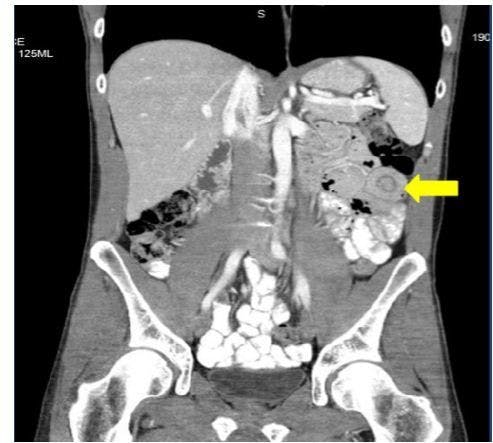 Intussusception in the Adult Patient: Rare, Ominous 