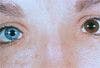 Heterochromia Iridis