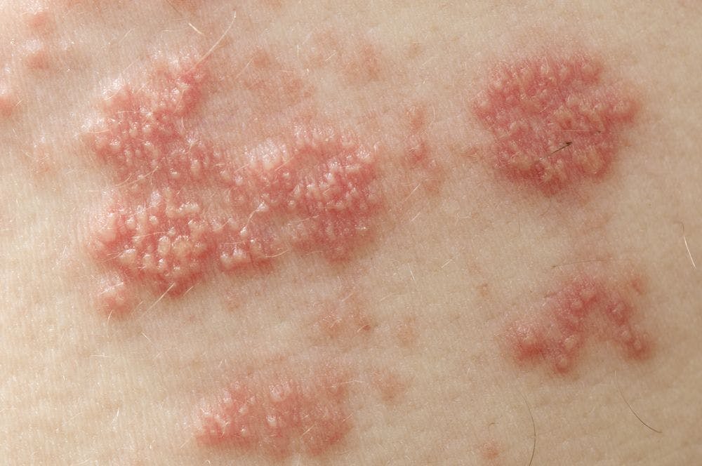 Herpes zoster rash 