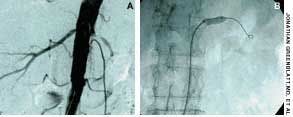 Renal Artery Stenosis Complicating Essential Hypertension