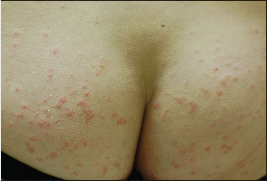 What caused this pruritic eruption on a woman’s arms, thighs, and buttocks?
