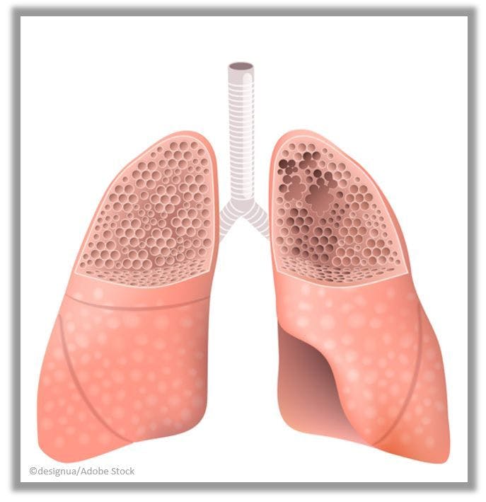 Dupilumab Achieves Outcomes in Phase 3 COPD Clinical Trial "Never Before Seen with a Biologic"
