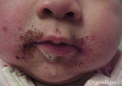 Oral Herpesvirus Infection With Impetigo Bullosa