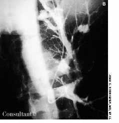 Pulmonary Arteriovenous Malformations
